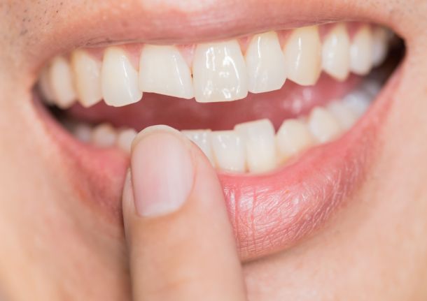 A woman pointing to her mouth showing a chipped tooth