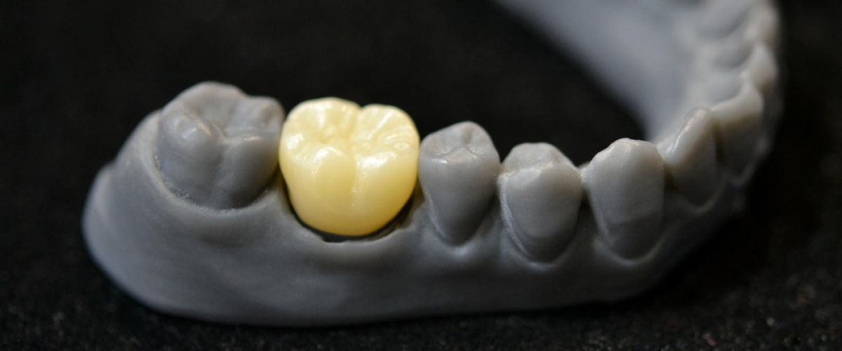 dental crown