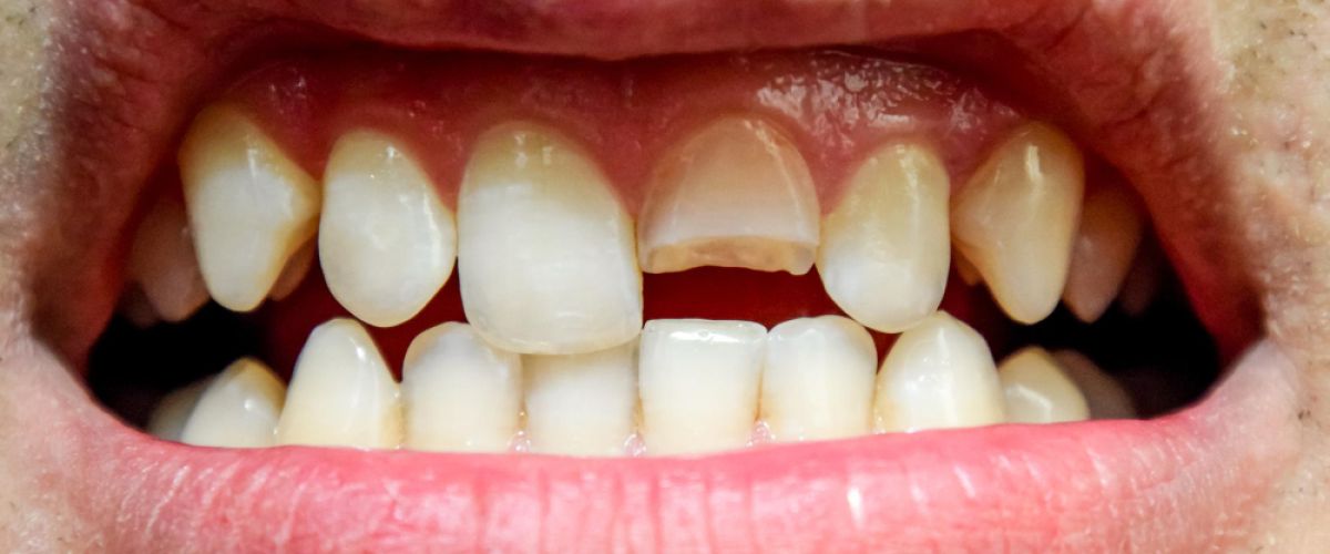 mouth of a man with a broken front tooth