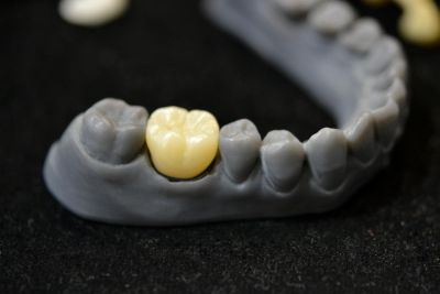 dental crown