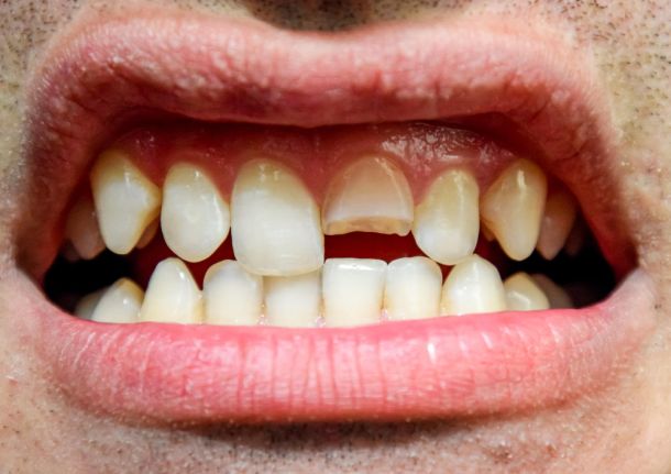 mouth of a man with a broken front tooth