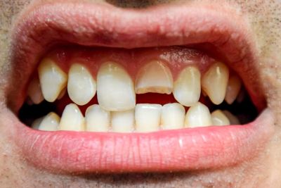 mouth of a man with a broken front tooth