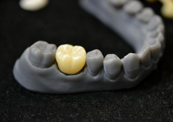 dental crown